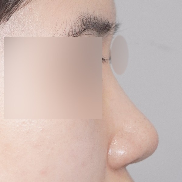 콧대,코끝,실리콘,비중격,귀연골,복코,짧은코