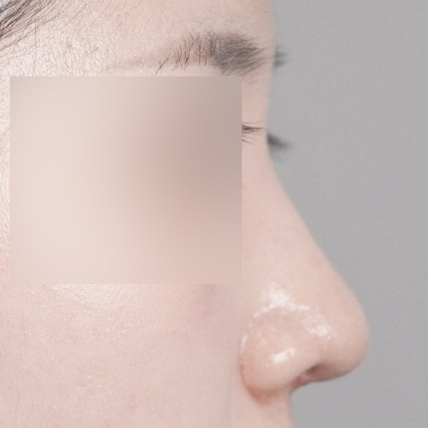 코끝,비중격,귀연골,복코,매부리,비순각